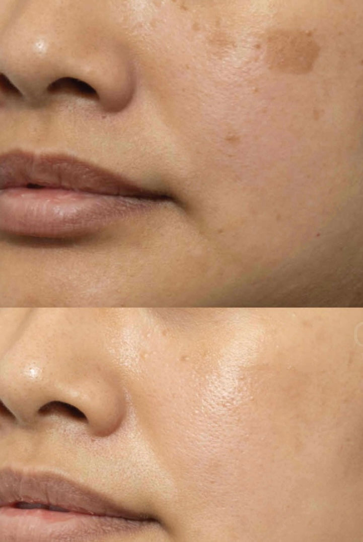 Tumeric hyperpigmentation soap bar